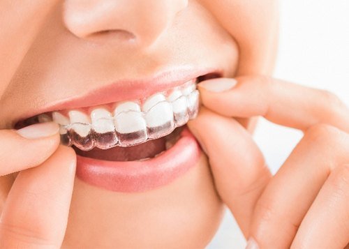 Invisalign