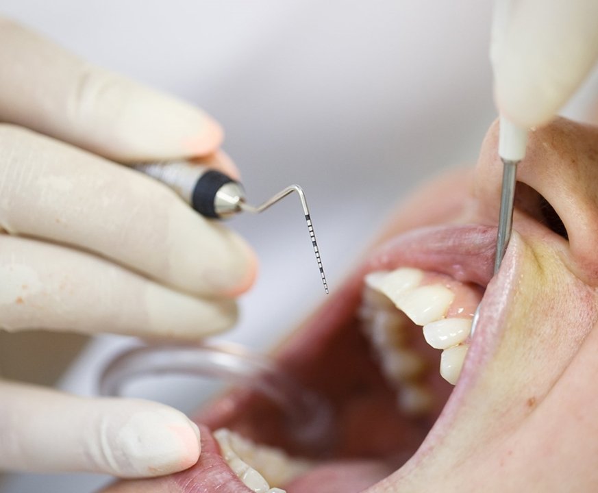 Gum Disease